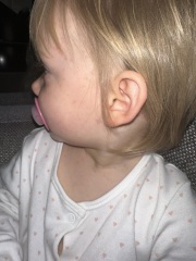 15 month old chickenpox or something different?