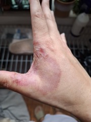 Hand-wash when having an extremely eczema breakout?