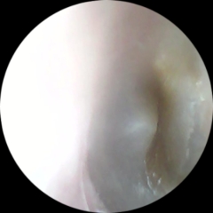 Normal eardrum?