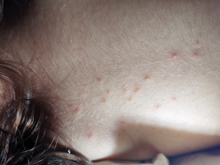 Toddler rash