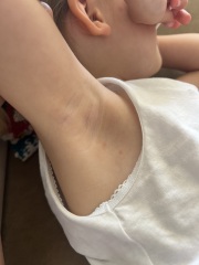 Advice Needed - Chickenpox or not?