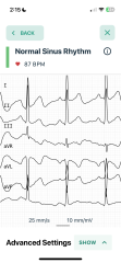ECG help - is this weird?