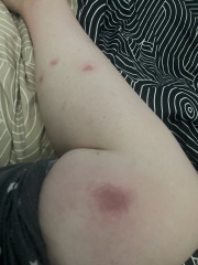 What on earth are these bites!