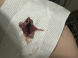 *GRAPHIC* i had a miscarriage at 7 weeks and i dont know what this is