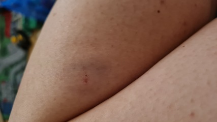 Spider or bug bite?