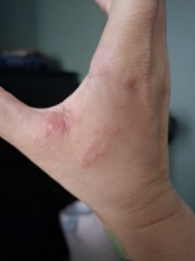 Any idea what this is on my hand? (Photo)