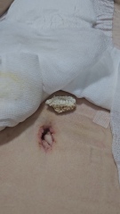 Tummy tuck *slightly graphic image* (edited by MNHQ)