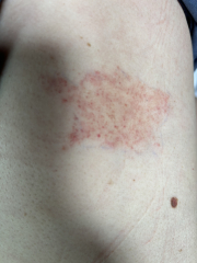 Infected bite?