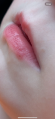 Cold sore?