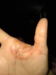 Hand infected (Warning, gross photos)