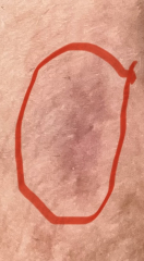 Painful lump in groin area