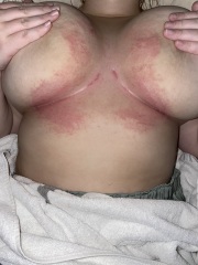 Spotty looking rash between breasts