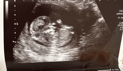 Boy 🩵 or Girl 🩷? Add your 12 week scans and guesses!