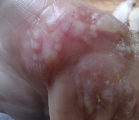 Hand infected (Warning, gross photos)