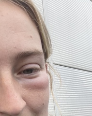 Woken up today with swelling under one eye? (Pics)
