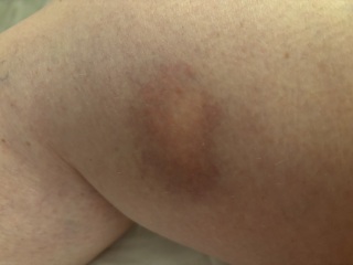 Skeeter Syndrome?