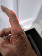 Hand infected (Warning, gross photos)