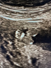 Potty shot @ 15 weeks, is it a boy???
