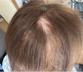 Post partum hairloss pics