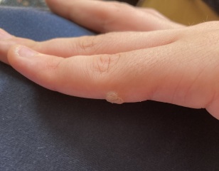 Is this a wart?