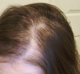 Hair thinning - panicking