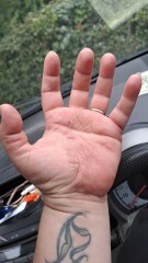 Methotrexate - Psoriasis