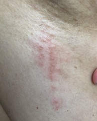 Rash under arm / breast