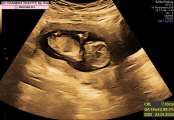 Nipt says girl, but ultrasound says boy!
