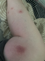 What on earth are these bites!