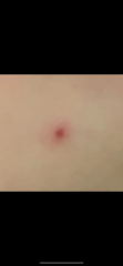 Spider angioma ??