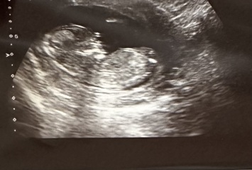 Boy 🩵 or Girl 🩷? Add your 12 week scans and guesses!