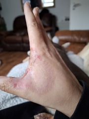 Hand infected (Warning, gross photos)