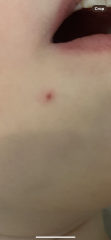 Spider Angioma?