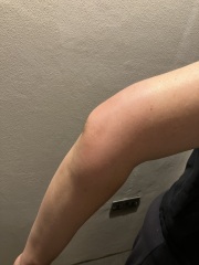 Worried about mosquito bite