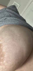 Breast cancer worry.