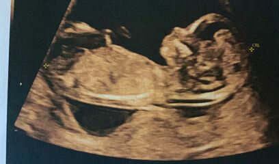 Boy or girl? 13 weeks ultrasound