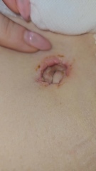 Tummy tuck *slightly graphic image* (edited by MNHQ)
