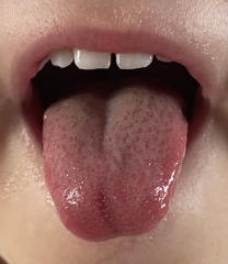 Strawberry tongue?