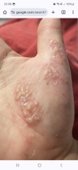 Hand infected (Warning, gross photos)