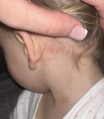 15 month old chickenpox or something different?