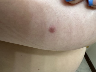 Spot of my breast