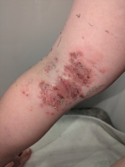 Infected bits getting worse?