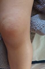Possible scabies on toddler??