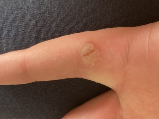 Is this a wart?