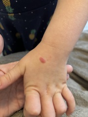 6 year old, red spot in hand