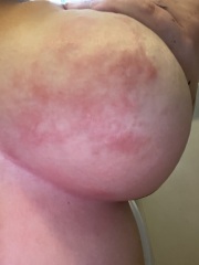 Spotty looking rash between breasts