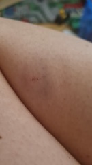 Spider or bug bite?