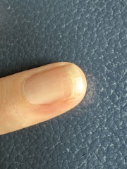 Start of a fungal nail infection?