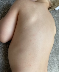 Have we got the dreaded chicken pox?