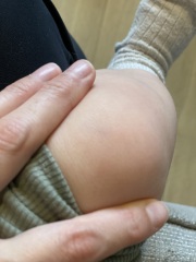 Little bruise and random single petechia that comes and goes